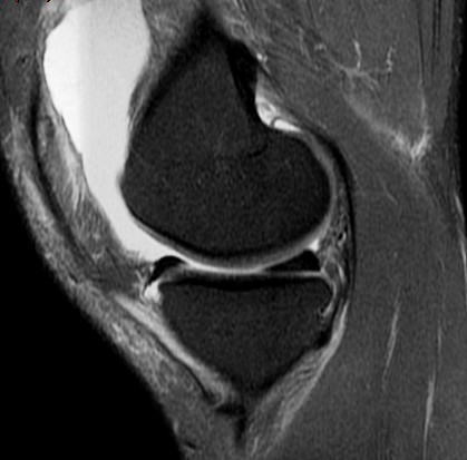 Figure 2 for case Patellar dislocation
